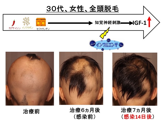 円形脱毛症　病院